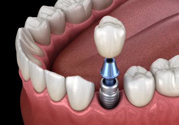Illustrated dental crown being placed onto dental implant