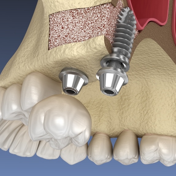 Illustrated dental crown being placed over dental implant in upper jaw