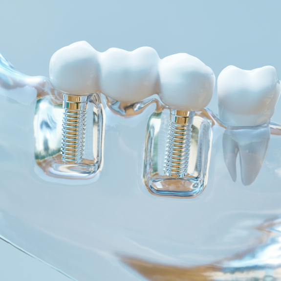 Model of the mouth with two dental implants in Cranford