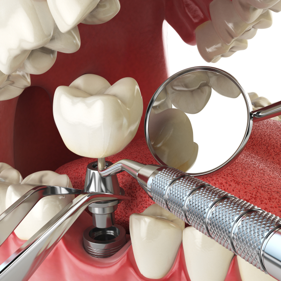 Illustrated dental implant with crown being placed in the lower arch