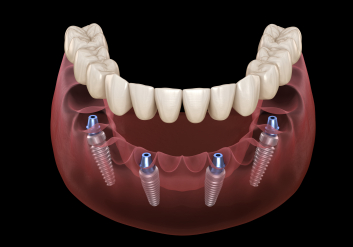 Illustrated implant denture being placed onto six dental implants