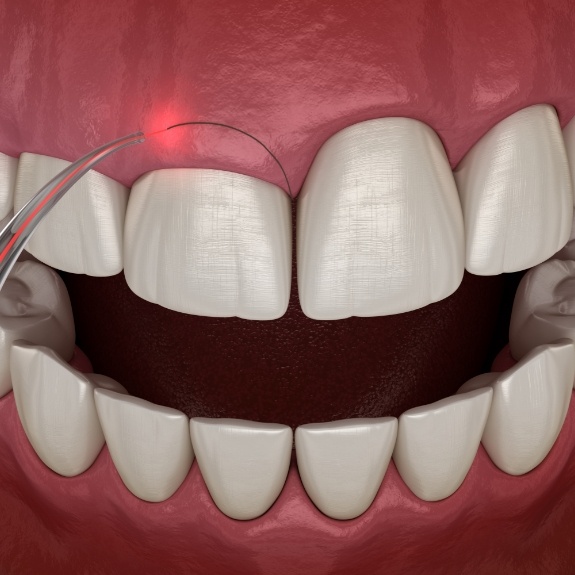 Illustrated dental laser performing crown lengthening to correct gummy smile