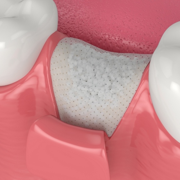 Illustrated tissue being grafted over jawbone where tooth is missing