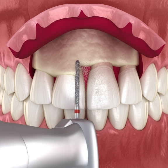 Illustrated dental instruments performing a gum graft