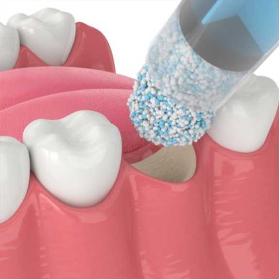 Illustrated bone grafting material being placed in jawbone where tooth is missing