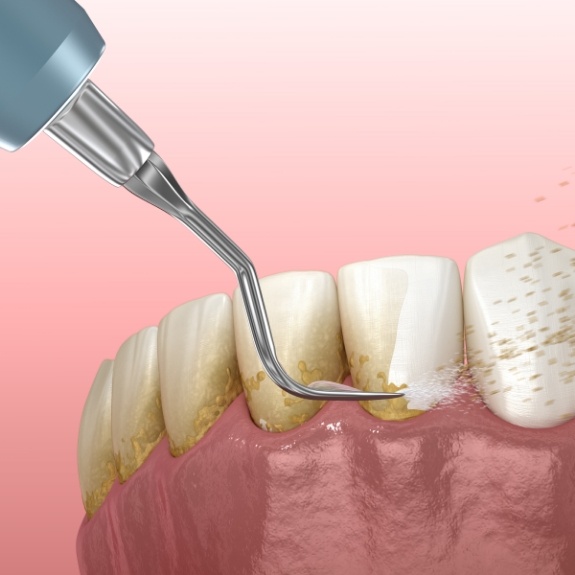 Animated dental instrument removing plaque buildup from teeth