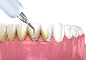 Illustration of scaler removing biofilm from teeth