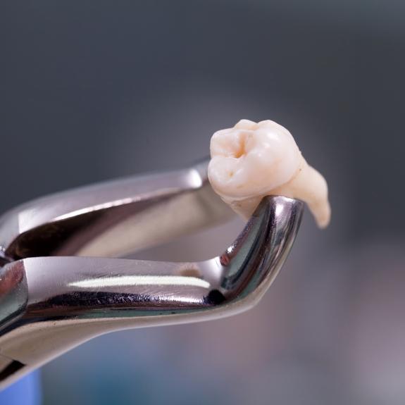 Dental forceps holding an extracted tooth