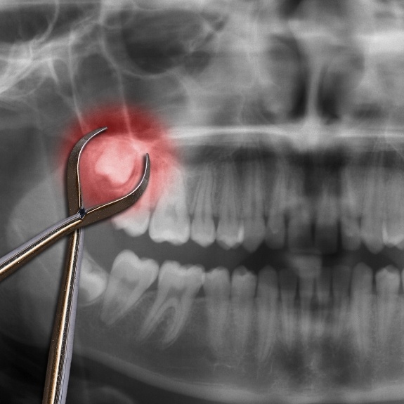 Dental forceps in front of x ray with impacted wisdom tooth highlighted red