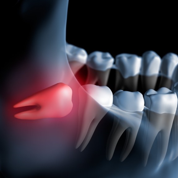 Illustrated impacted wisdom tooth pressing against back molar