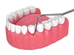Illustration of dental probe touching periodontal pocket