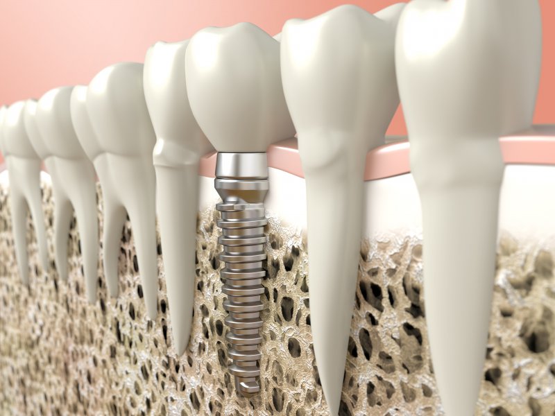 Closeup of dental implant