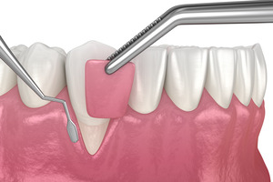 Illustration of a gum grafting procedure